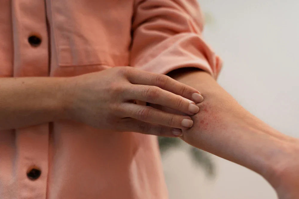 Dermatitis Atópica: Causas y 10 Remedios Naturales 2026